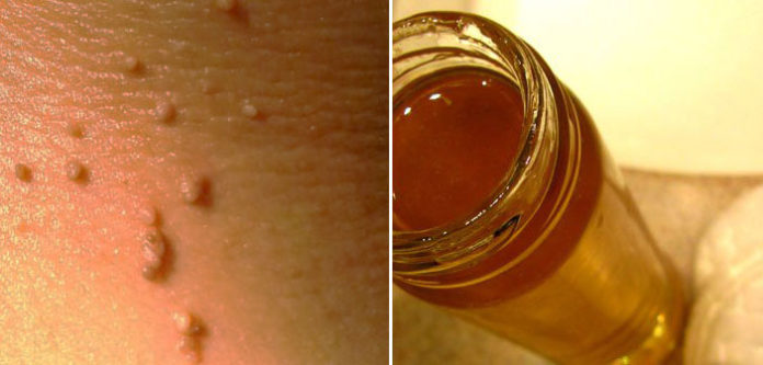 fibromi