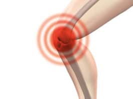 Kako izliječiti artritis na prirodan način?