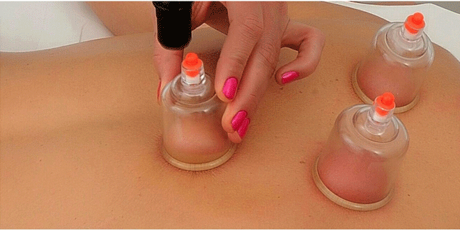 cupping