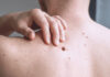 Zašto je važno rano prepoznavanje melanoma?