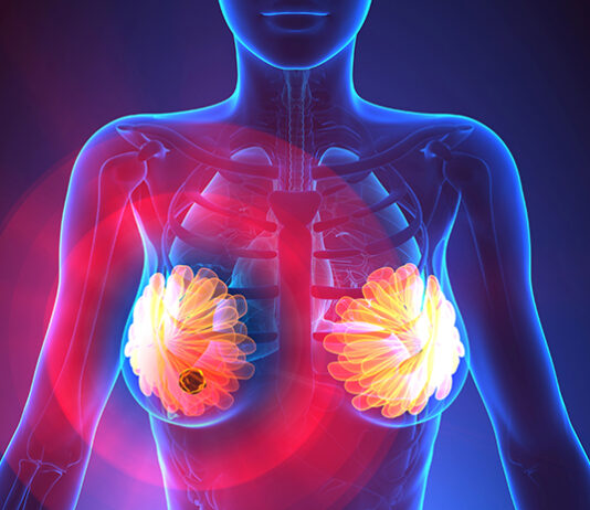 Mastopatija, miomi i rak dojke: Dubinski uzroci i prirodni pristup iscjeljenju